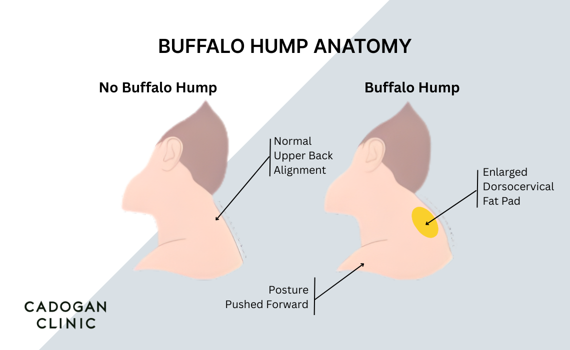 Infographic showing the placement of the dorsocervical fat pad at the base of the neck in cases of buffalo hump